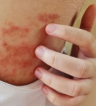 אטופיק דרמטיטיס